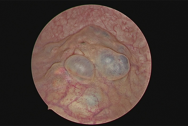 GENITO URINARY ENDOMETRIOSIS
