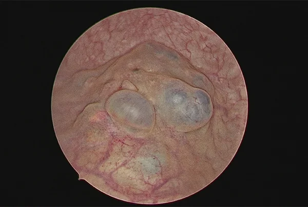 GENITO URINARY ENDOMETRIOSIS