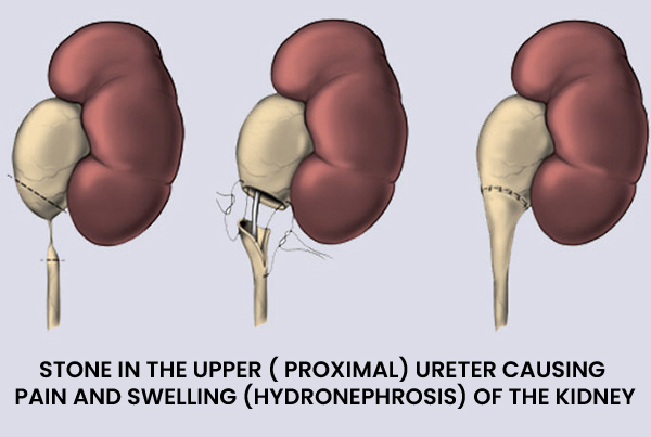 Ureter