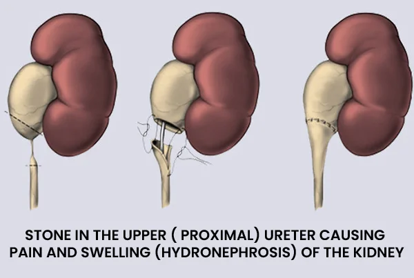 URETER