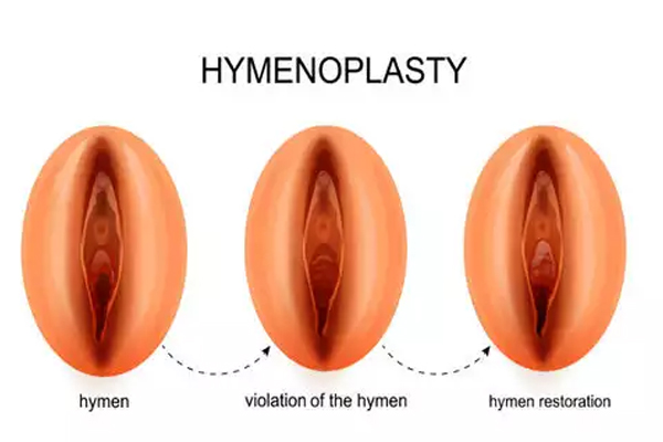 HYMENOPLASTY