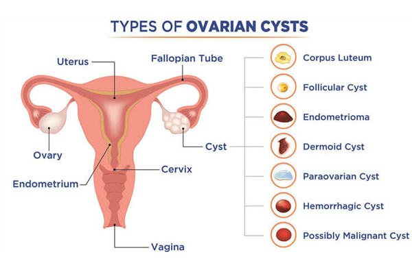 OVARIAN CYSTECTOMY