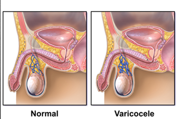 Varicocele