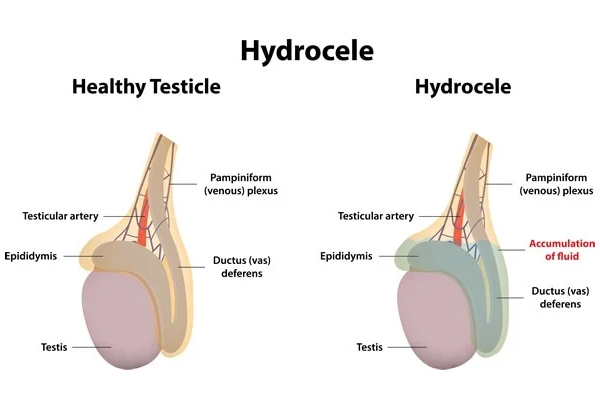 Hydrocele