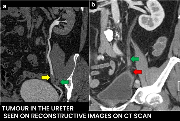 URETERIC TUMOR
