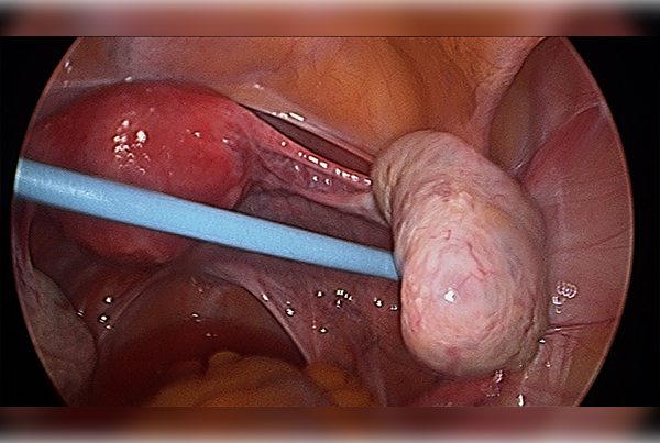 OVARIAN DRILLING