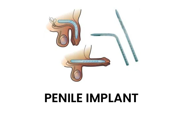 Penile Girth Enhancing and Penile Implant Surgery